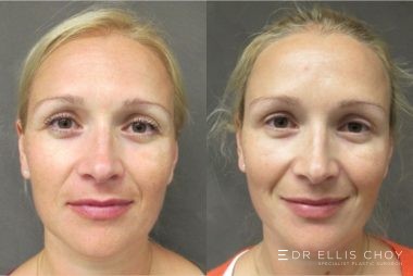 Anti Wrinkle Injections Before And After Photos Sydney Au