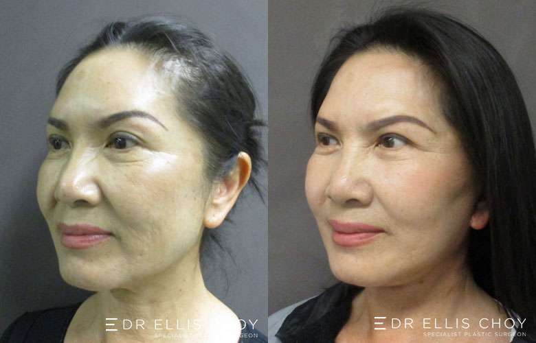 Face And Neck Lift Before & After Photos - Dr Ellis Choy