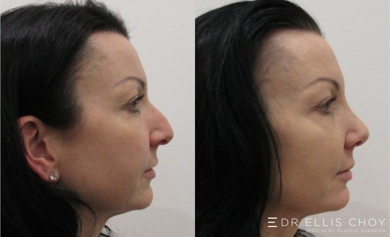 Rhinoplasty (Nose Surgery) Before & After - Dr Choy