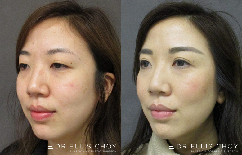 Asian Blepharoplasty (Eyelid Surgery) Before & After Photos