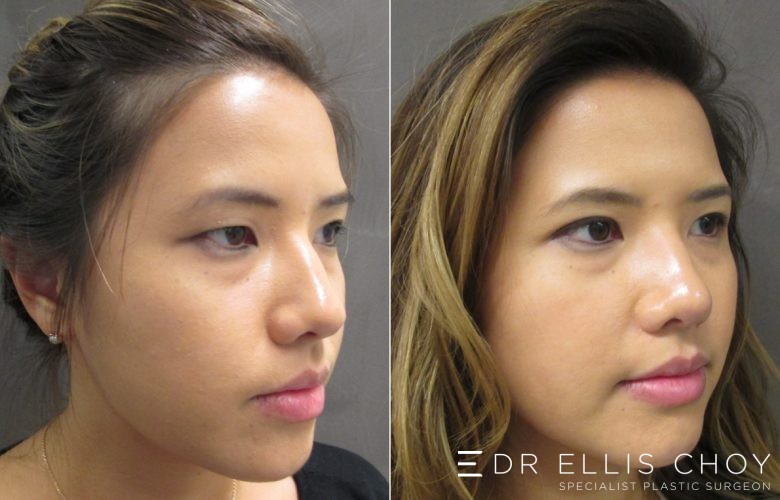 asian eyelid surgery before and after pictures