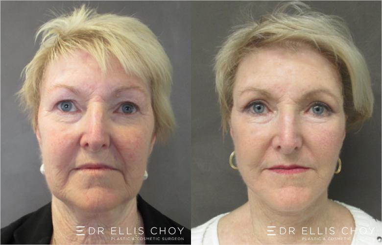 facelift surgery patient